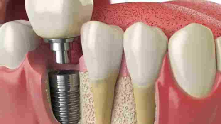 Имплантация зуба: преимущества установки импланта за один день